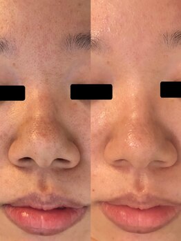 ツヤハダコガオ 千葉店/before⇒afterハーブピーリング