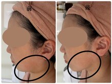 カリアンヌ/小顔/むくみ/リフトアップ/毛穴