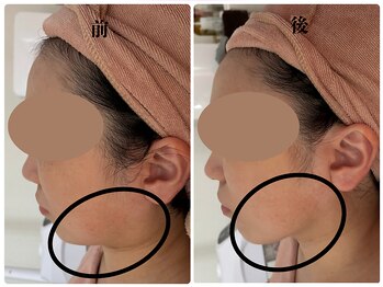 カリアンヌ/小顔/むくみ/リフトアップ/毛穴