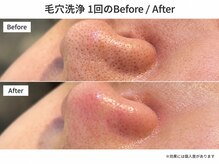 ビーマジック(Be Magic)の雰囲気（毛穴洗浄1回の変化をビフォーアフターで確認）