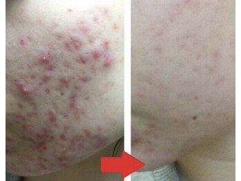 サロンリーナ 銀座店(SalonLena)/グリーンピール★Befor→After