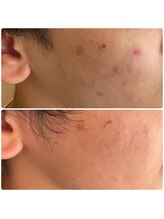 ニカ(NiCA)/2週に1度　3回照射