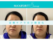 コルギ専門店 マキシフォート 栄店(Maxifort)/定期ケアでの小顔変化