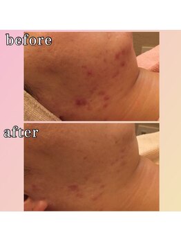 プリマジュール/ニキビに働きかける