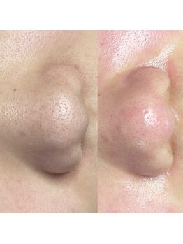 キキ(kiki)/だいぶ毛穴改善されてきました