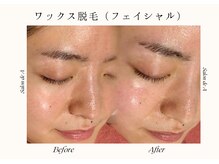 サロンドエー 帝塚山(Salon de A)/WAX脱毛で艶肌・水光肌