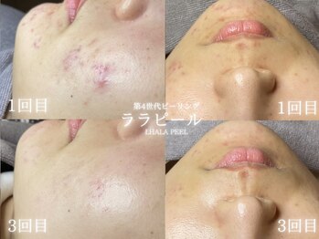 リル 和歌山市店(lilou)/ララピールBefore After