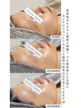 クレヴィー(Creviy)/ハーブピーリング4回経過