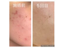 エムローズ(M.rose)の雰囲気（最先端つるっとブラックピールで肌質・毛穴改善★）