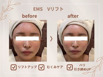 シロ(CHILO)/EMS Vリフト