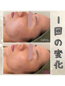 プルーム 久留米店(plume)/ハーブピーリング