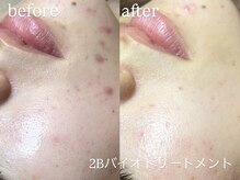 エーアール(ar)/ハーブピーリング/2Bバイオ