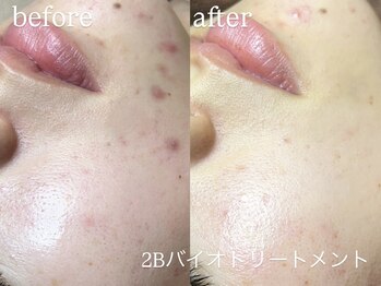 エーアール(ar)/ハーブピーリング/2Bバイオ