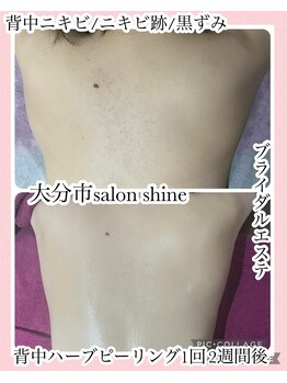 サロンシャイン(Salon Shine)/背中の黒ずみ、角栓
