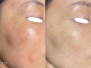 ダリア(Dahlia)/シミケアにもハーブピーリング