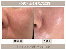 リヨン(Lyon)/（40代）たるみ毛穴引き締め