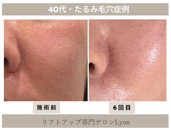 リヨン(Lyon)/（40代）たるみ毛穴引き締め