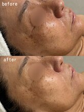 スパ ナナプラス(SPA nana+)/美白ケア◎光フェイシャル