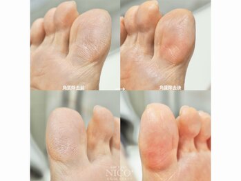 ニコプラス 大橋店(NICO+)/足裏角質除去