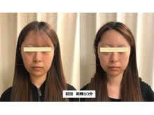 ナチュレアンドメディカ(Nature&Medica)/【たるみor小顔】オンダフェイス