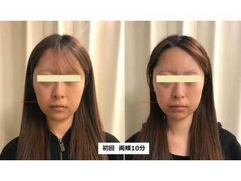 ナチュレアンドメディカ(Nature&Medica)/【たるみor小顔】オンダフェイス