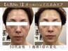 【初めての方へ】シミ・シワ・たるみ・ハリ不足に☆未来の肌をつくる肌質改善