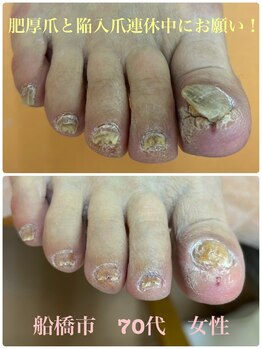 巻き爪じゅん 船橋店/母の肥厚爪と陥入爪この連休中に