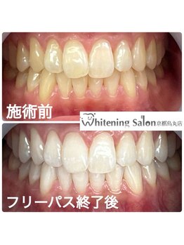 ホワイトニングサロン 京都烏丸店/ホワイトニング施術例