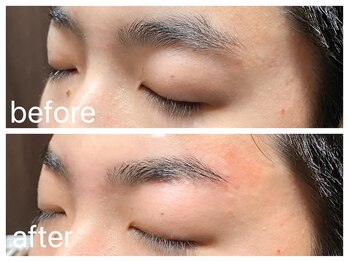 クラシックス(CLASSICS)/眉毛脱毛