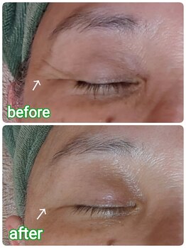 ニワ(Niwa)/バザルトフェイシャル施術例