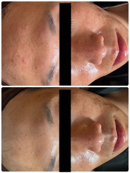 悠羽(yuuwa)/ニキビの肌荒れ改善