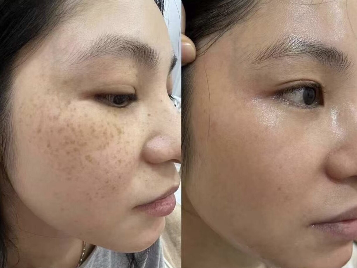 肌質改善エステサロン♡ 水戸市エステサロンCerenoa♡これからの季節に艶肌waxおすすめ♡松ヤニ