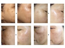 ラパス(Lapaz)の雰囲気（純粋レチノールピールで様々な肌悩みにアプローチ。再生美容ケア）