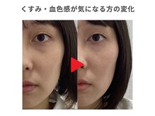 ひもとき整体院/骨格に合わせた美容鍼♪
