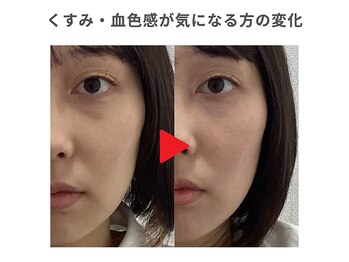 ひもとき整体院/骨格に合わせた美容鍼♪