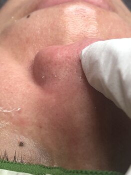 エステティックサロン グリーンアイ 浦和店(green.i)/毛穴/ララピール/小顔/たるみ