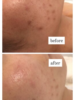 ビー ブルーム(B BLOOM)/【ニキビケア】繰り返さない肌へ