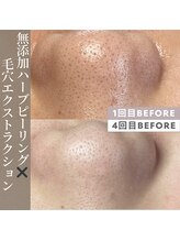 キキ(kiki)/１回目ビフォーと４回目ビフォー