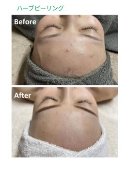 エム(M)/ハーブピーリング