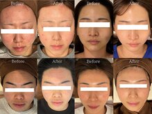 ヒジ(Life Salon)の雰囲気（お顔ハーブピーリング◎Before /After）