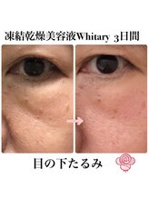 ケンビラク(Kenbiraku 健美楽)/目の下のたるみ　3日間