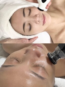 ルーナ 恵比寿(Luna)の写真/【最新フラクショナルRF+サーマルリフト】引き締め小顔へ★お得な人気セットで施術後の効果を速攻実感♪