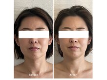 ジョリー(jolie)/新メニュー！病みつき★小顔矯正