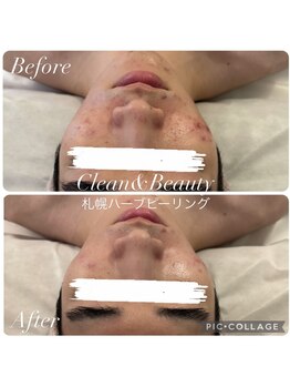 クリーンアンドビューティ 札幌(Clean&Beauty)/お悩みに合わせてコントロール!