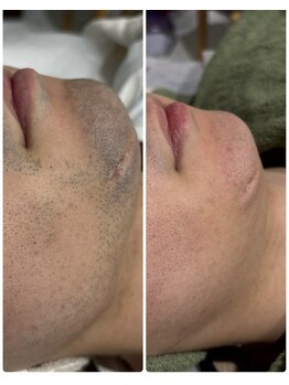 アロラヴィ(AroRavi)/ヒゲ脱毛