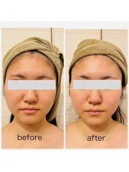 ルミエール(Lumiere.)/顔筋リフトフェイシャル比較写真