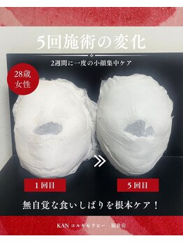 KANコルギセラピー 福井店の写真/眼精疲労＆食いしばりからのエラ張り、頬から引く上げるアプローチが好評◎韓国式ならではの結果を実感◎