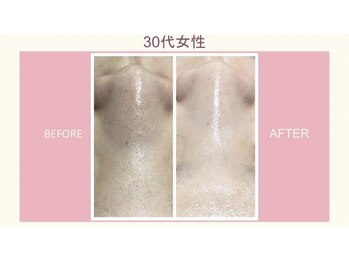 ファウンデーション(FOUNDATION)/黒ずみケア