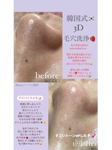 クレヴィー(Creviy)/韓国式3D毛穴洗浄(初回1回目)