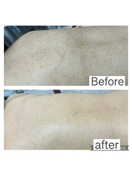 オアジスパ(Oasi Spa)/黒いプツプツサメ肌Greenpeel4回